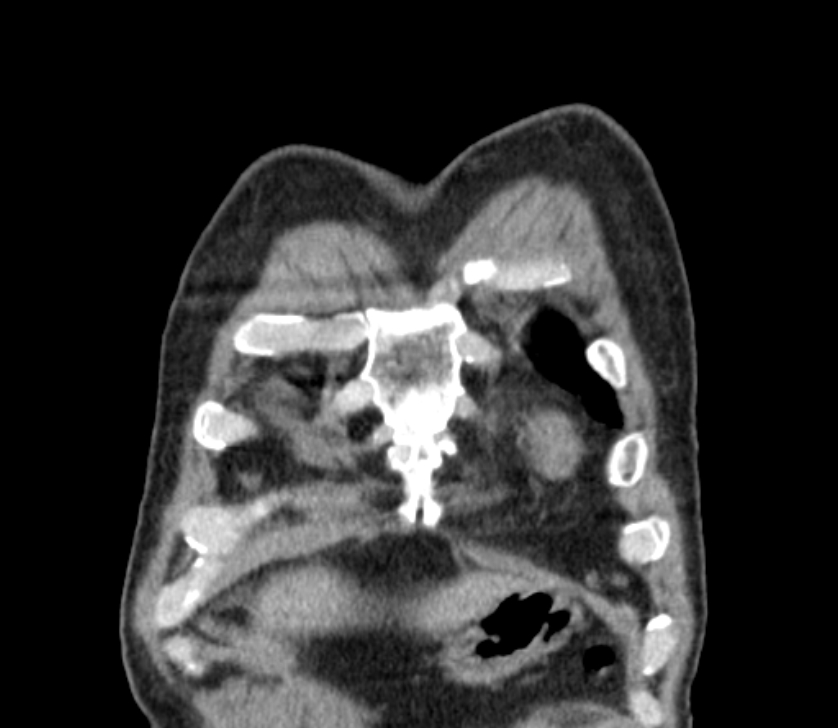 Airway foreign body in adult (Radiopaedia 85907-101779 Coronal liver window 13).jpg