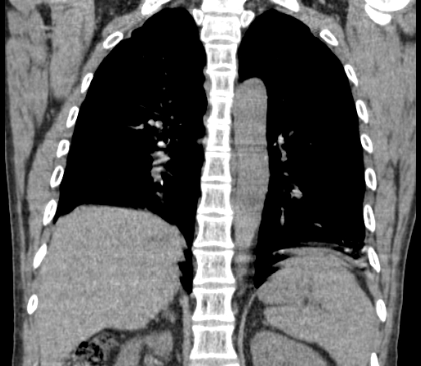 Airway foreign body in adult (Radiopaedia 85907-101779 Coronal liver window 181).jpg