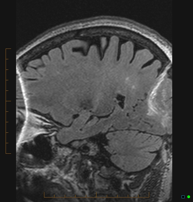 Aliasing artifact causing a spurious cerebellar lesion (Radiopaedia 48783-53810 Sagittal FLAIR 81).jpg