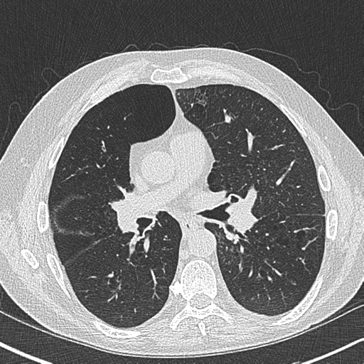 Allergic bronchopulmonary aspergillosis (Radiopaedia 44760-48571 Axial lung window 33).png
