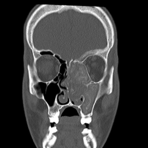 File:Allergic fungal sinusitis (Radiopaedia 29086-29455 Coronal bone window 13).jpg