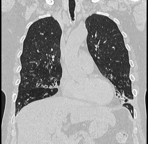 Alpha-1-antitrypsin deficiency (Radiopaedia 72058-82557 Coronal lung window 24).jpg