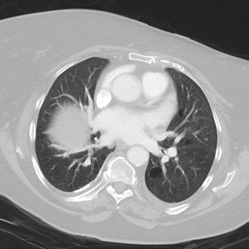Alveolar hemorrhage and possible lymphocytic interstitial pneumonitis in systemic lupus erythematosus (Radiopaedia 28582-28839 Axial lung window 27).jpg
