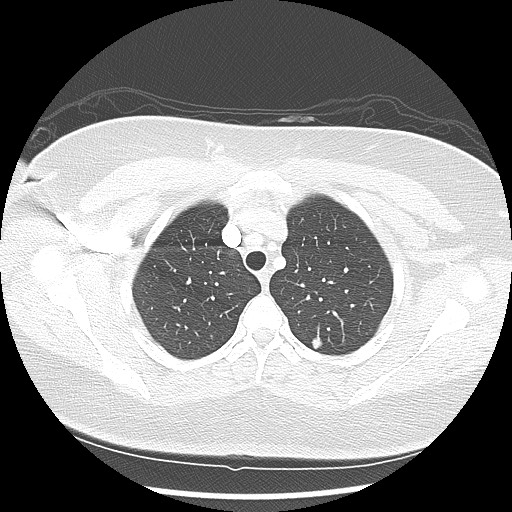 Alveolar soft part sarcoma - right leg (Radiopaedia 59432-67091 Axial lung window 25).jpg