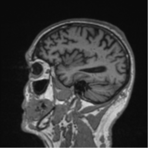 Alzheimer's disease- with Gerstmann syndrome and dressing apraxia (Radiopaedia 54882-61150 Sagittal T1 16).png