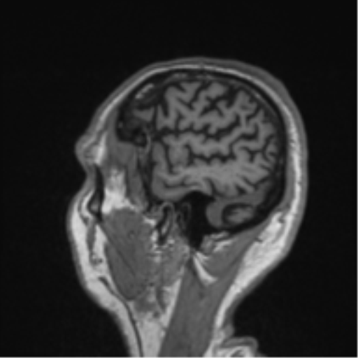 Alzheimer's disease- with Gerstmann syndrome and dressing apraxia (Radiopaedia 54882-61150 Sagittal T1 62).png