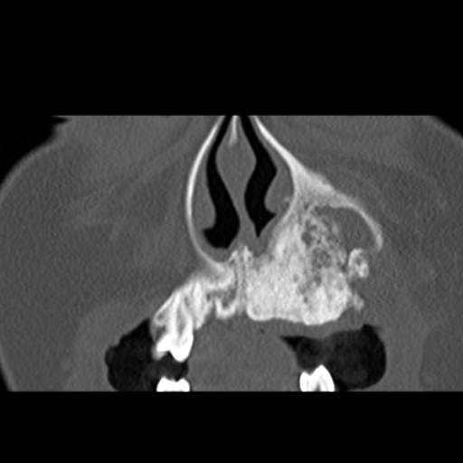 File:Ameloblastic fibro-odontoma (Radiopaedia 18843-18780 B 7).jpg