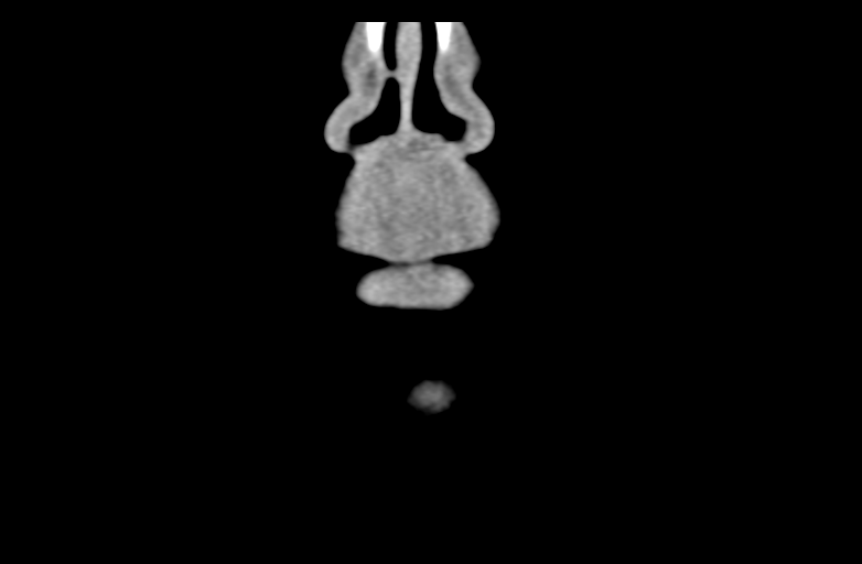 Ameloblastoma (Radiopaedia 33677-34806 Coronal non-contrast 9).png