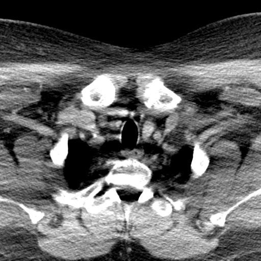 Ameloblastoma (Radiopaedia 38520-40623 Axial non-contrast 74).png