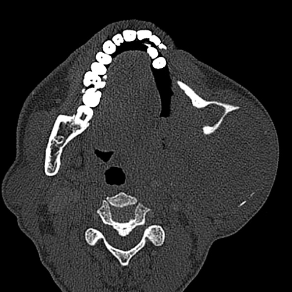 Ameloblastoma (Radiopaedia 51921-57766 Axial bone window 76).jpg