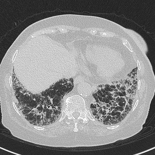 Amiodarone-induced pulmonary fibrosis (Radiopaedia 82355-96460 Axial lung window 55).jpg
