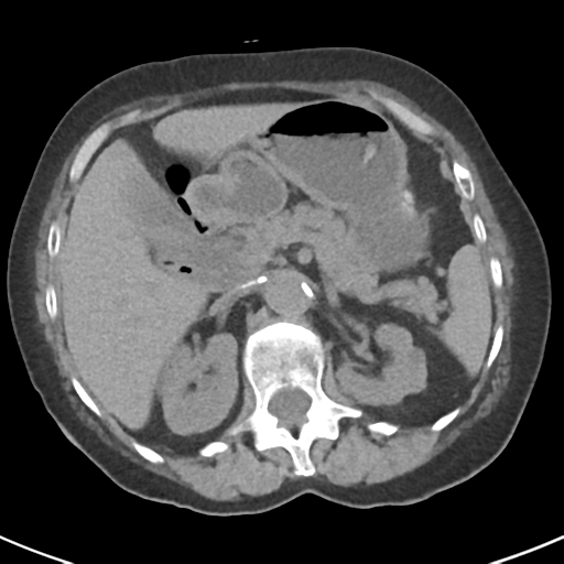 File:Ampullary adenocarcinoma (Radiopaedia 34013-35237 Axial non-contrast 17).png