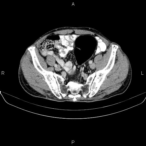File:Ampullary adenocarcinoma (Radiopaedia 86093-102032 A 46).jpg