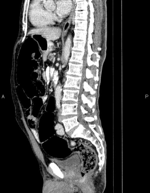 Ampullary adenocarcinoma (Radiopaedia 86093-102032 D 51).jpg