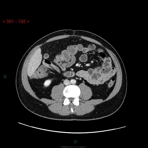 File:Ampullary carcinoma (Radiopaedia 56396-63056 C 56).jpg