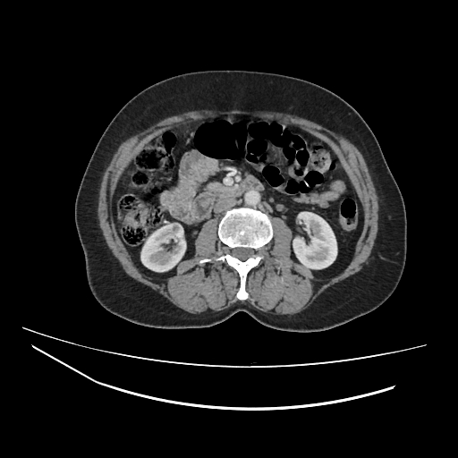 Ampullary tumor (Radiopaedia 60333-67998 A 38).jpg