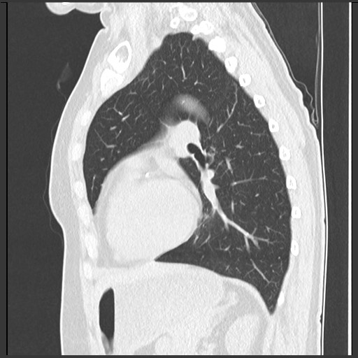 Amyloidosis - bronchial and diffuse nodular pulmonary involvement (Radiopaedia 60156-67744 F 36).jpg