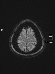 Amyotrophic lateral sclerosis (Radiopaedia 70821-81017 Axial SWI 55).jpg