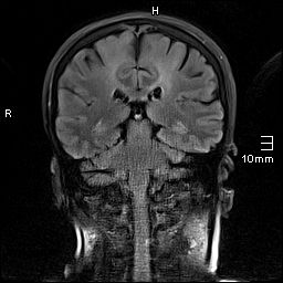 File:Amyotrophic lateral sclerosis (Radiopaedia 70821-81017 Coronal FLAIR 17).jpg