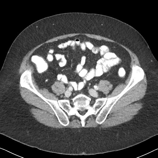 Anal adenocarcinoma - tumor regression grade 1 (Radiopaedia 31358-32103 Axial POST 53).jpg