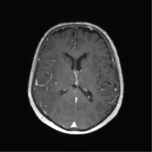 File:Anaplastic astrocytoma (Radiopaedia 86943-103160 Axial T1 C+ 35).png