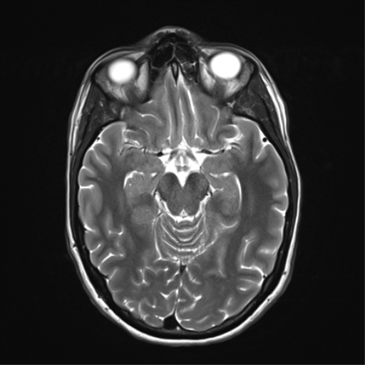 File:Anaplastic astrocytoma IDH mutant (Radiopaedia 50046-55341 Axial T2 16).png