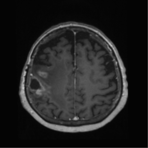 File:Anaplastic astrocytoma IDH wild-type (pseudoprogression) (Radiopaedia 42209-45278 Axial T1 C+ 113).png