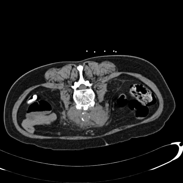Anaplastic lymphoma - with CT biopsy (Radiopaedia 21643-21602 Axial non-contrast 47).jpg