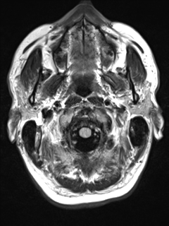 File:Anaplastic meningioma with recurrence (Radiopaedia 34452-35788 Axial T2 FLAIR 1).png