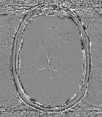 Anaplastic oligodendroglioma (Radiopaedia 83500-98599 Axial SWI - phase 47).png