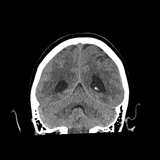File:Aneursym related subarachnoid hemorrhage with hydrocephalus (Radiopaedia 45105-49083 Coronal non-contrast 47).jpg