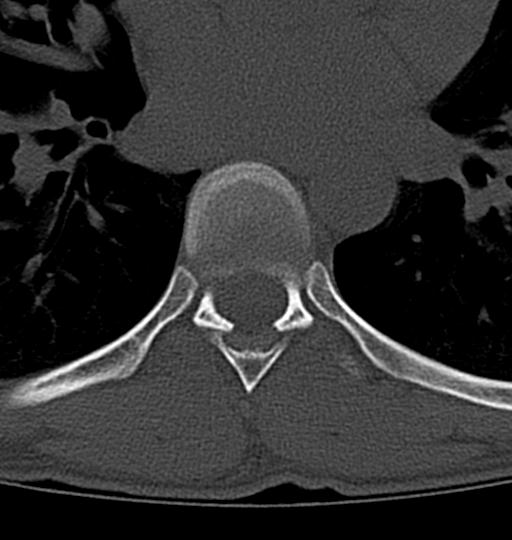 Aneurysmal bone cyst T11 (Radiopaedia 29294-29721 Axial bone window 10).jpg