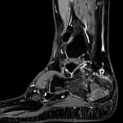File:Aneurysmal bone cyst of the calcaneus (Radiopaedia 60669-68420 F 6).jpg