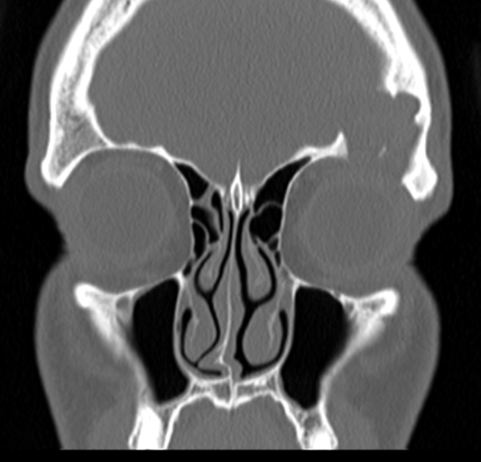 Angular epidermoid cyst (Radiopaedia 46908-51439 Coronal bone window 23).png