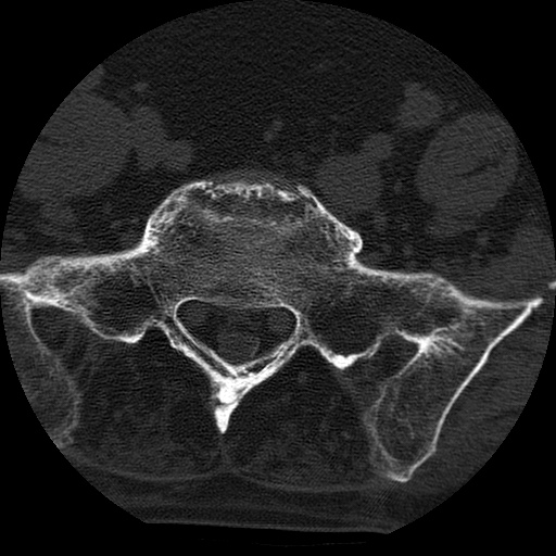 Ankylosing spondylitis complicated by fracture-dislocation (Radiopaedia 33583-34674 Axial non-contrast 149).jpg