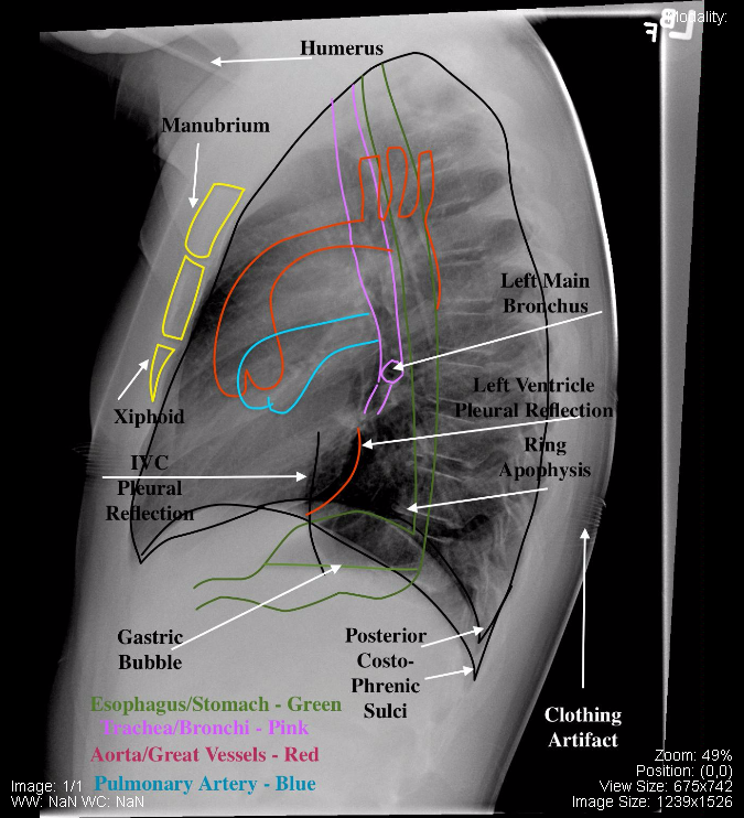 Annotated Normal Pediatric Lateral Chest x-ray.png
