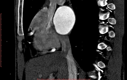 File:Anomalous left coronary artery from the pulmonary artery (ALCAPA) (Radiopaedia 70148-80181 C 61).jpg