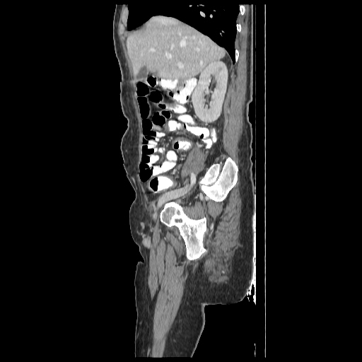 Anorectal carcinoma (Radiopaedia 44413-48064 C 29).jpg