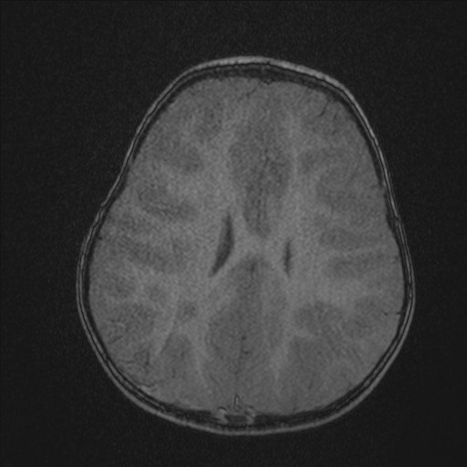 Anoxic brain injury (Radiopaedia 79165-92139 Axial MRA 173).jpg