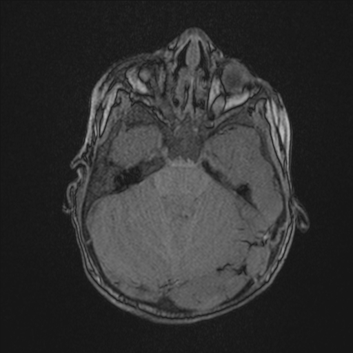 Anoxic brain injury (Radiopaedia 79165-92139 Axial MRA 64).jpg