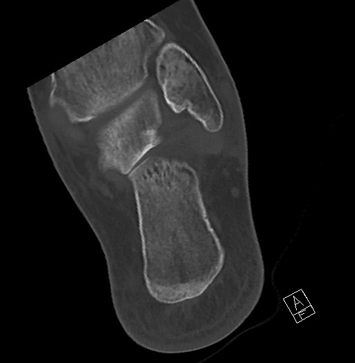 Anterior calcaneal process fracture (Radiopaedia 63353-71943 Axial bone window 112).jpg