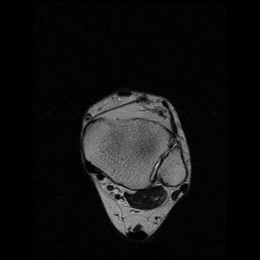 File:Anterior calcaneal process fracture (Radiopaedia 74654-85611 Axial T2 4).jpg