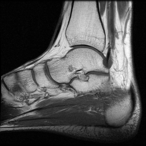 File:Anterior calcaneal process fracture (Radiopaedia 74654-85611 Sagittal T1 9).jpg