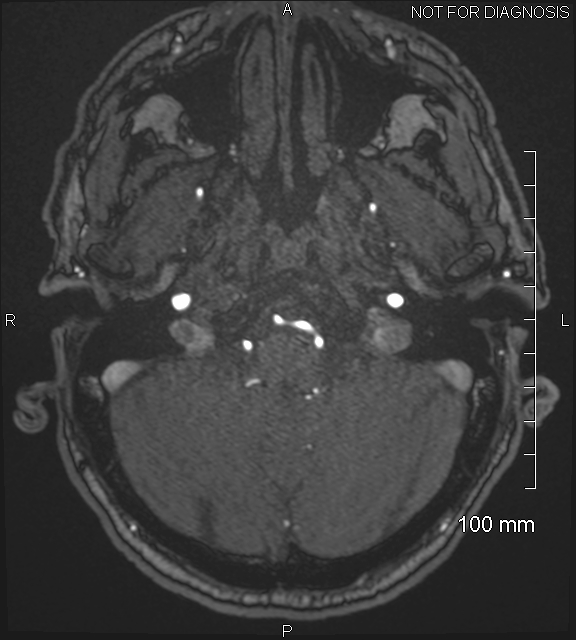 Anterior cerebral artery aneurysm (Radiopaedia 80683-94127 Axial MRA 35).jpg