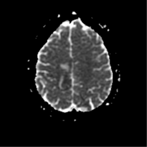 File:Anterior cerebral artery territory infarct (Radiopaedia 39327-41584 Axial ADC 20).png