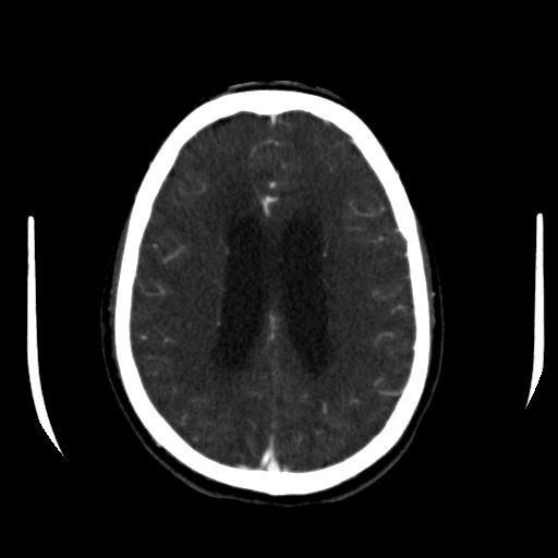 File:Anterior communicating artery aneurysm (Radiopaedia 16633-16335 A 30).jpg