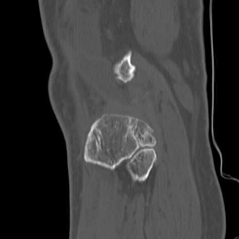 File:Anterior cruciate ligament avulsion fracture (Radiopaedia 58939-66194 Sagittal bone window 5).jpg