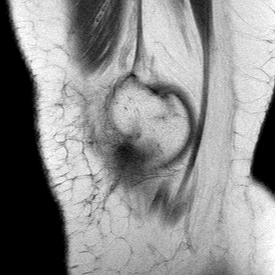 Anterior cruciate ligament mucoid degeneration (Radiopaedia 60853-68633 Sagittal T1 35).jpg