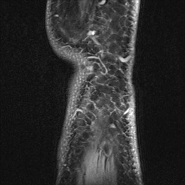 Anterior cruciate ligament tear - ramp lesion (Radiopaedia 71883-82322 Sagittal T1 vibe 8).jpg