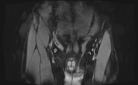 Anterior inferior iliac spine avulsion fracture (Radiopaedia 81312-95000 G 101).jpg